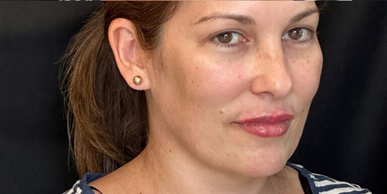 After Image: Lip Filler by Dr. Costeloe - right-front-oblique