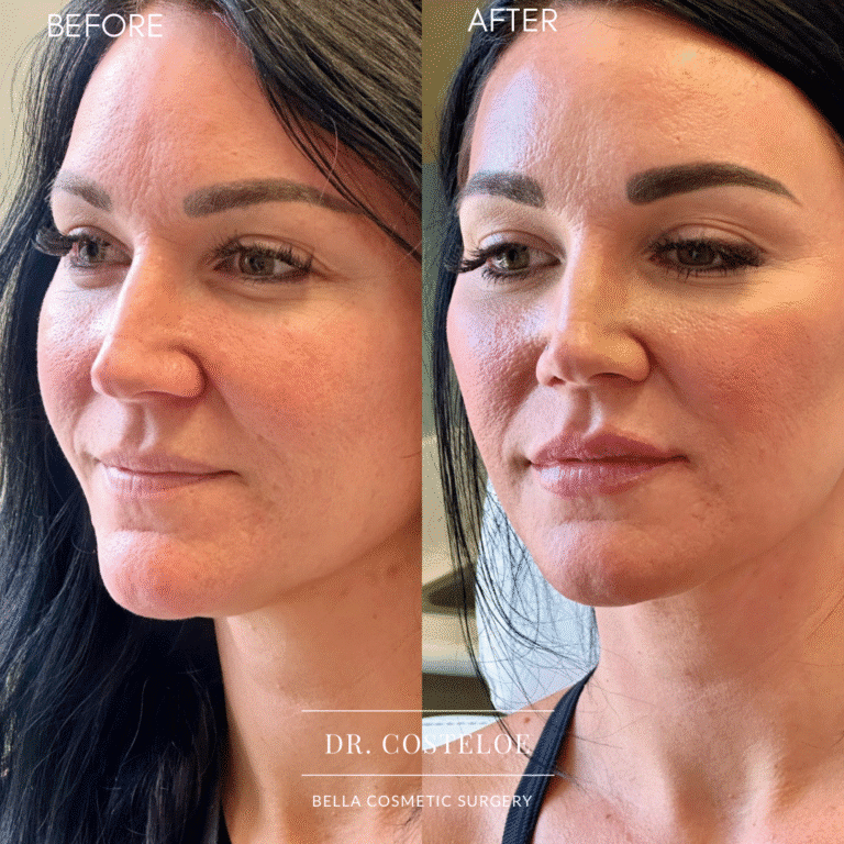 After Image: Lip Filler by Dr. Costeloe - left-front-oblique