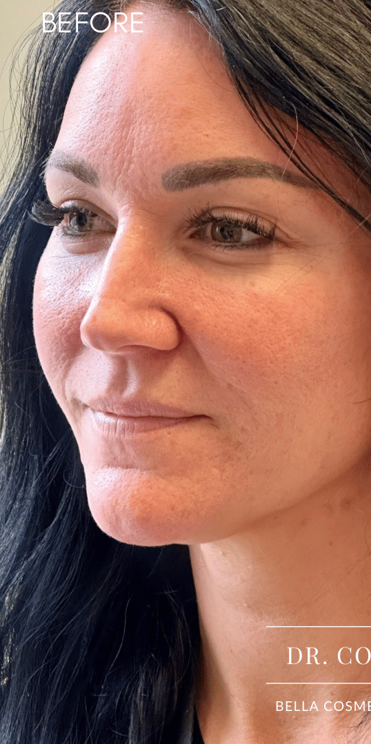 Before Image: Lip Filler by Dr. Costeloe - left-front-oblique