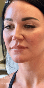 After Image: Lip Filler by Dr. Costeloe