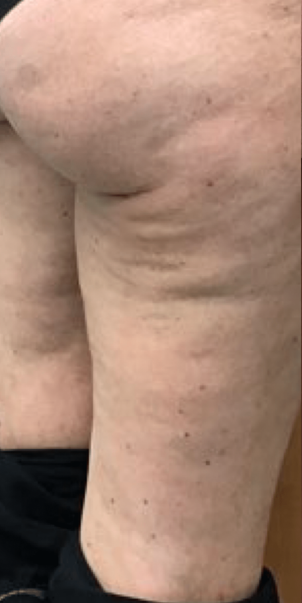 Before Image: Radiesse for Cellulite - right-back-oblique