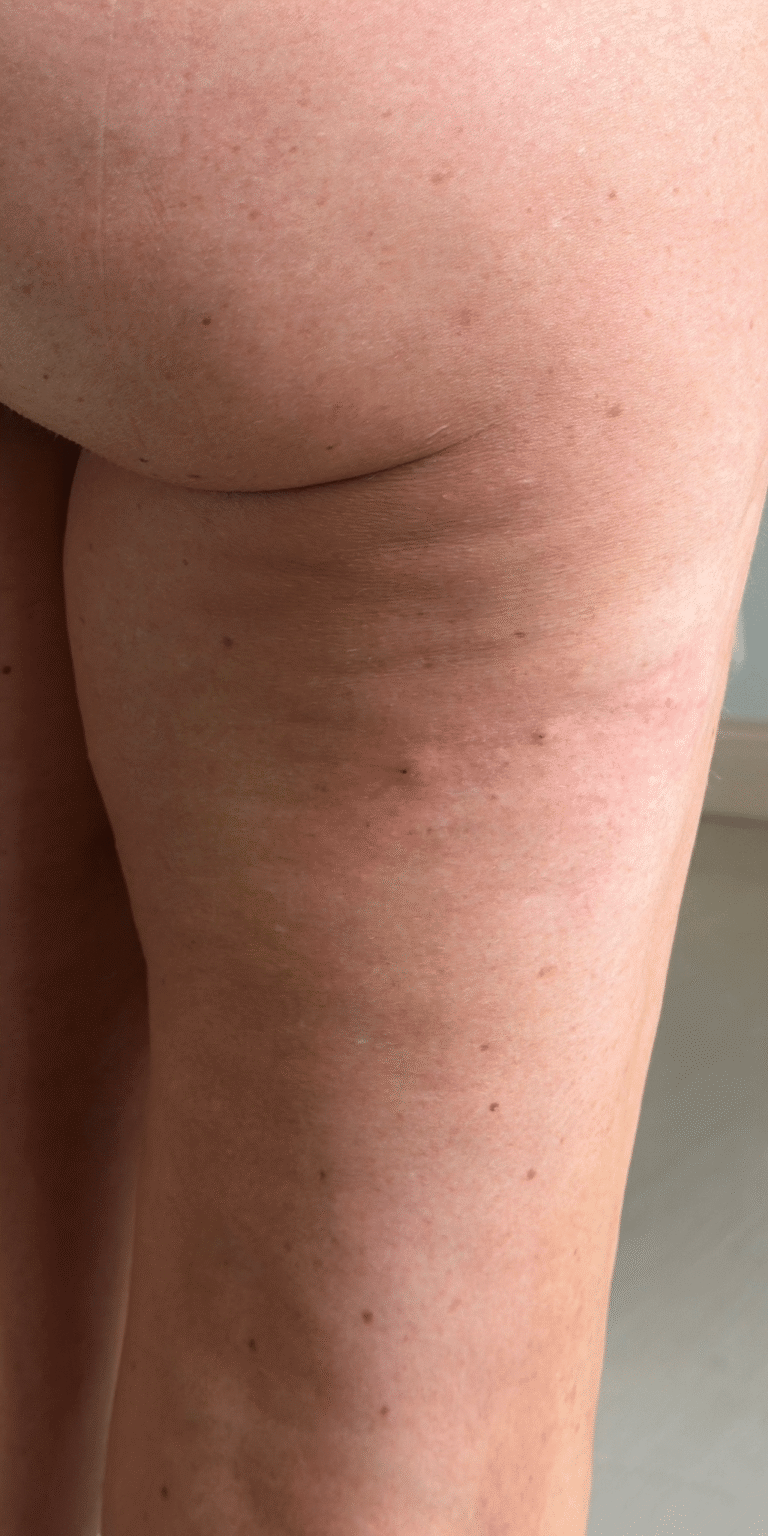 After Image: Radiesse for Cellulite - right-back-oblique