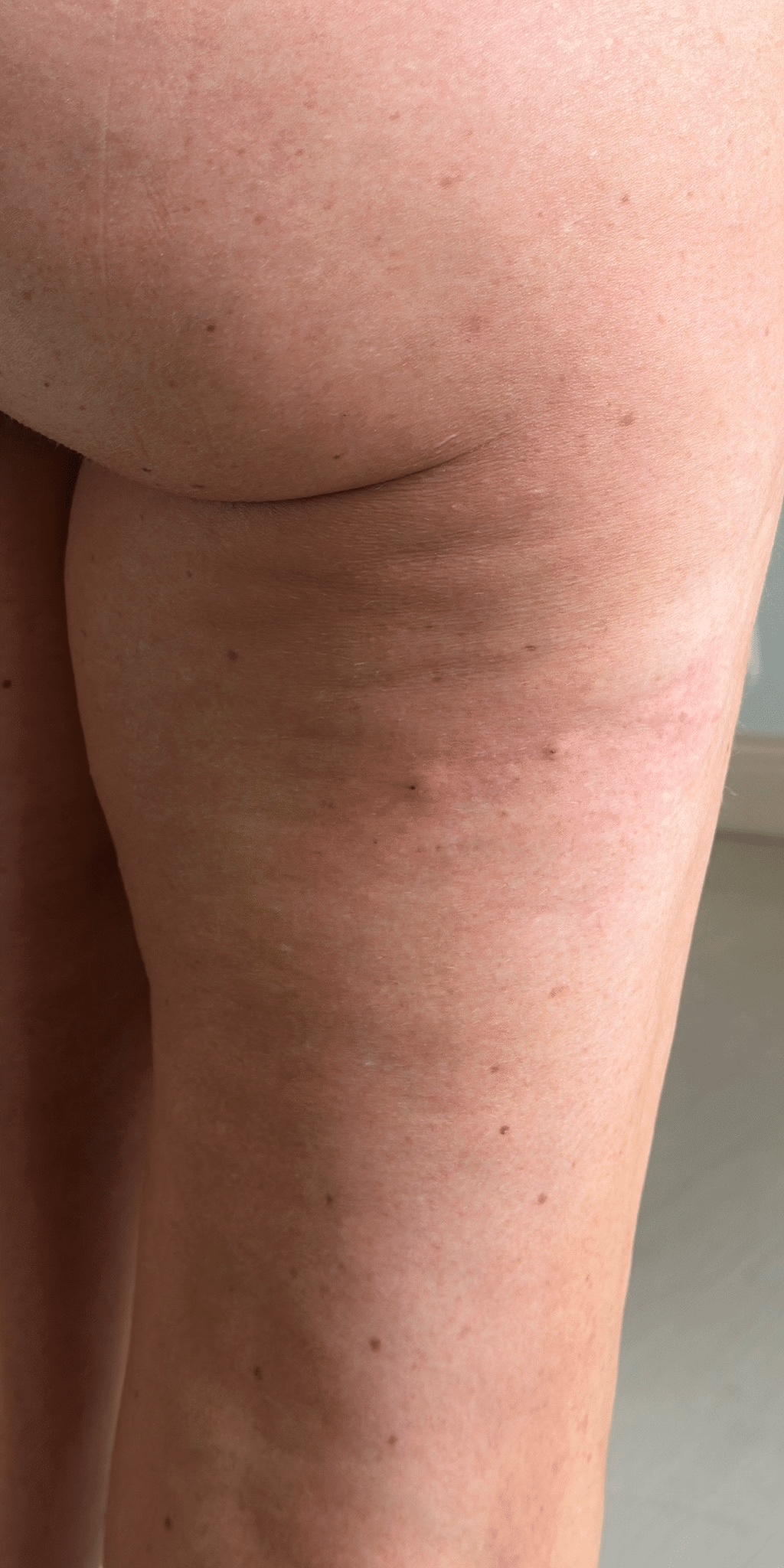 After Image: Radiesse for Cellulite - right-back-oblique
