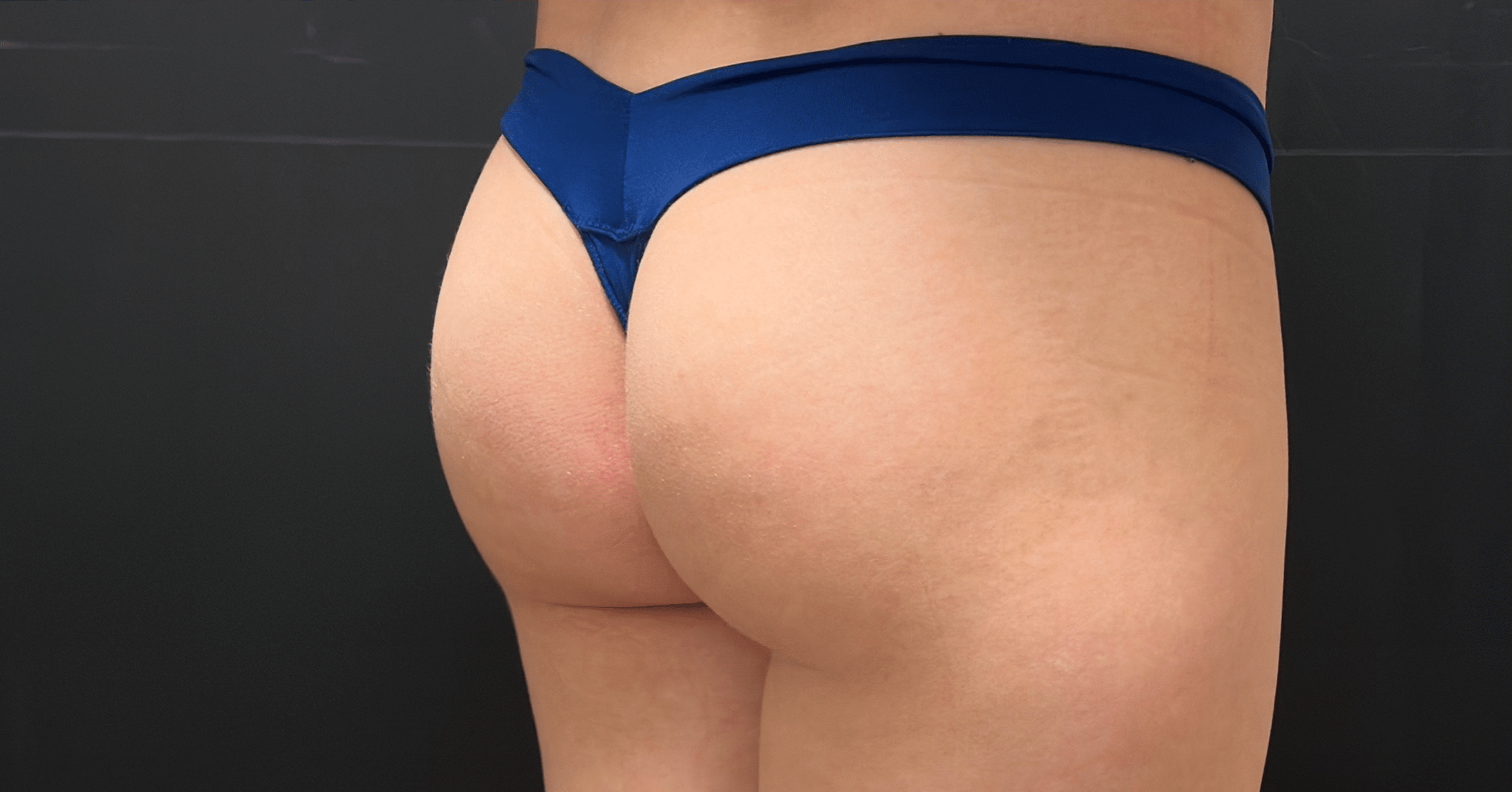 After Image: Sculptra Butt Augmentation - right-back-oblique