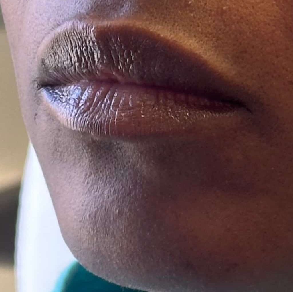 Before Image: Lip Filler by Dr. Costeloe - left-front-oblique