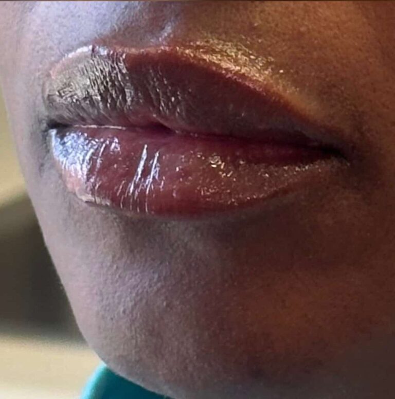 After Image: Lip Filler by Dr. Costeloe - left-front-oblique