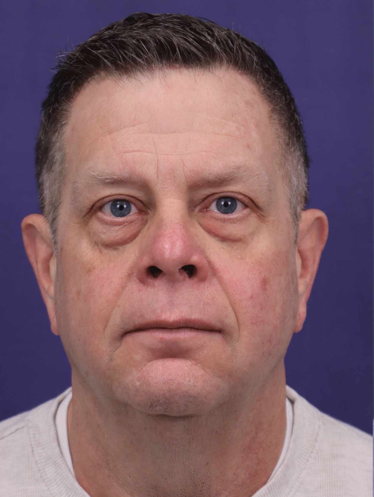 Before Image: Upper and Lower Blepharoplasty with fat transposition, fat grafting
