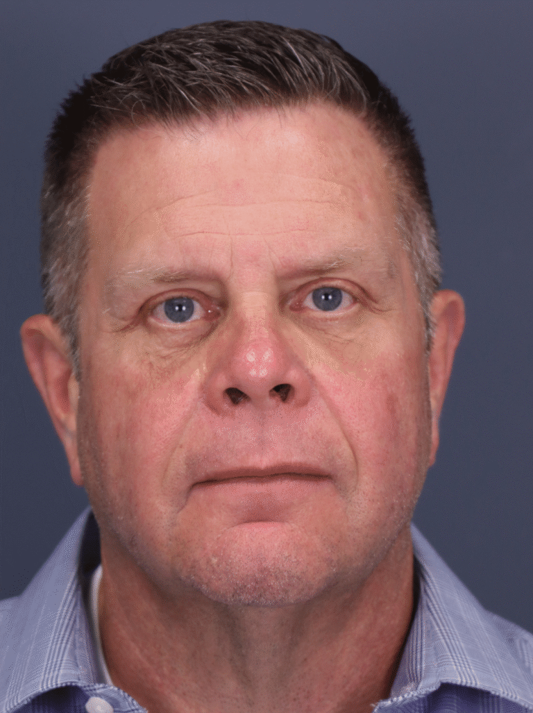 After Image: Upper and Lower Blepharoplasty with fat transposition, fat grafting - front