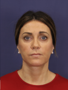 After Image: Deep Plane Face Lift & Extended Deep Plane Neck Lift