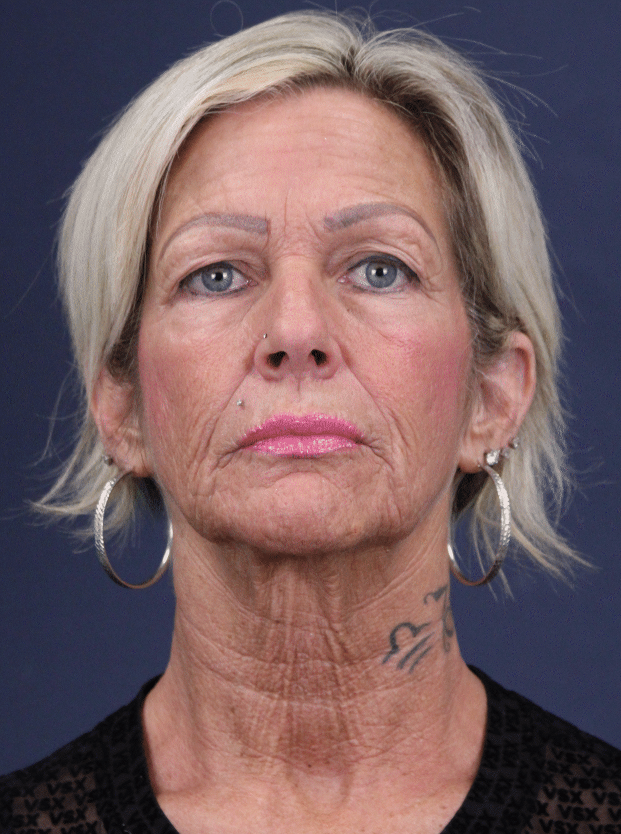 Before Image: Mini facelift and Necklift, Upper Blepharoplasty, EarLobe Repair