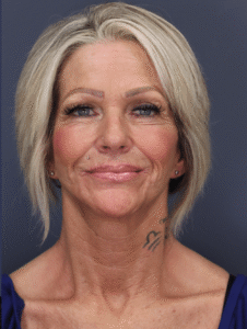 After Image: Mini facelift and Necklift, Upper Blepharoplasty, EarLobe Repair