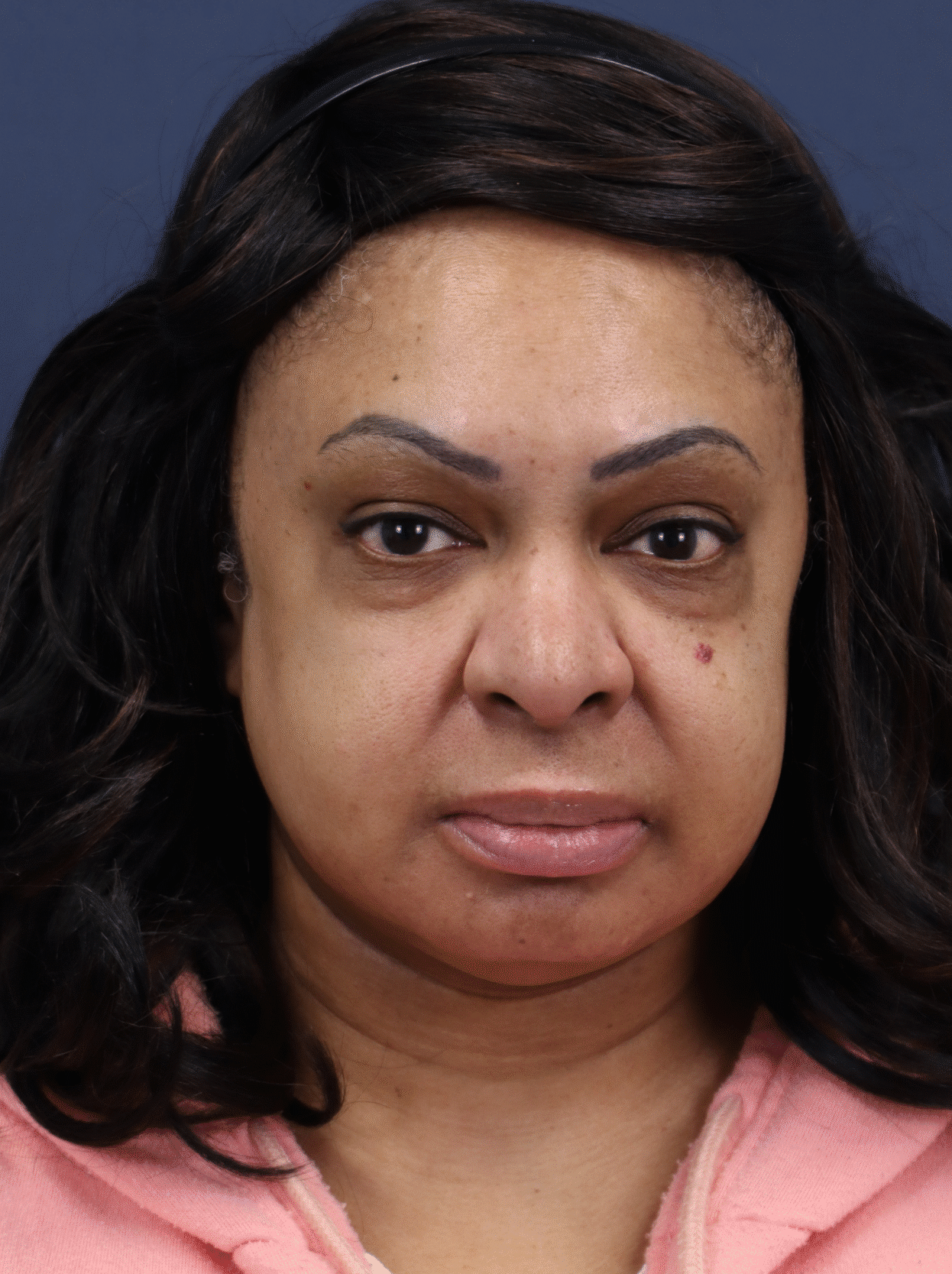 Before Image: Lower Blepharoplasty, fat transposition, fat transfer - front