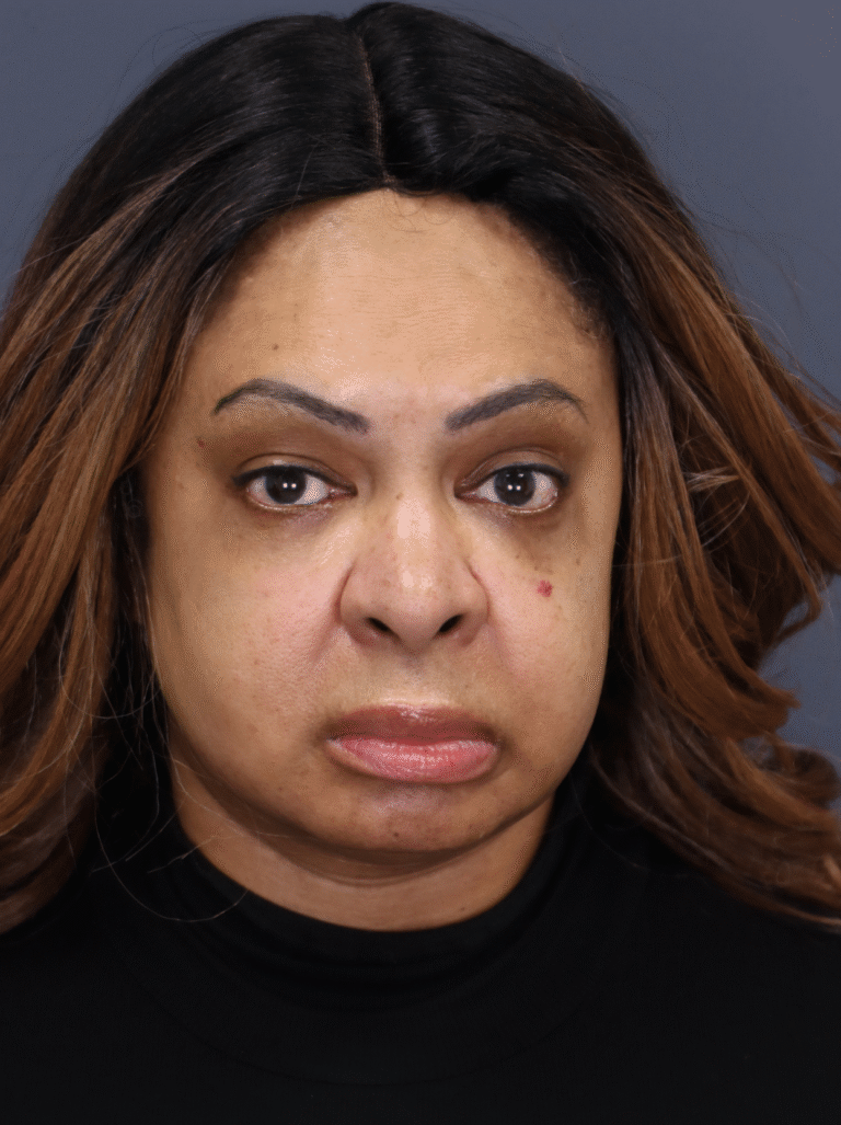 After Image: Lower Blepharoplasty, fat transposition, fat transfer - front