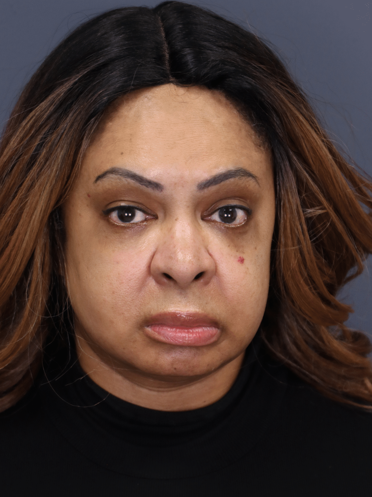 After Image: Lower Eyelid Lift with Fat transposition & Facial Fat Grafting - front