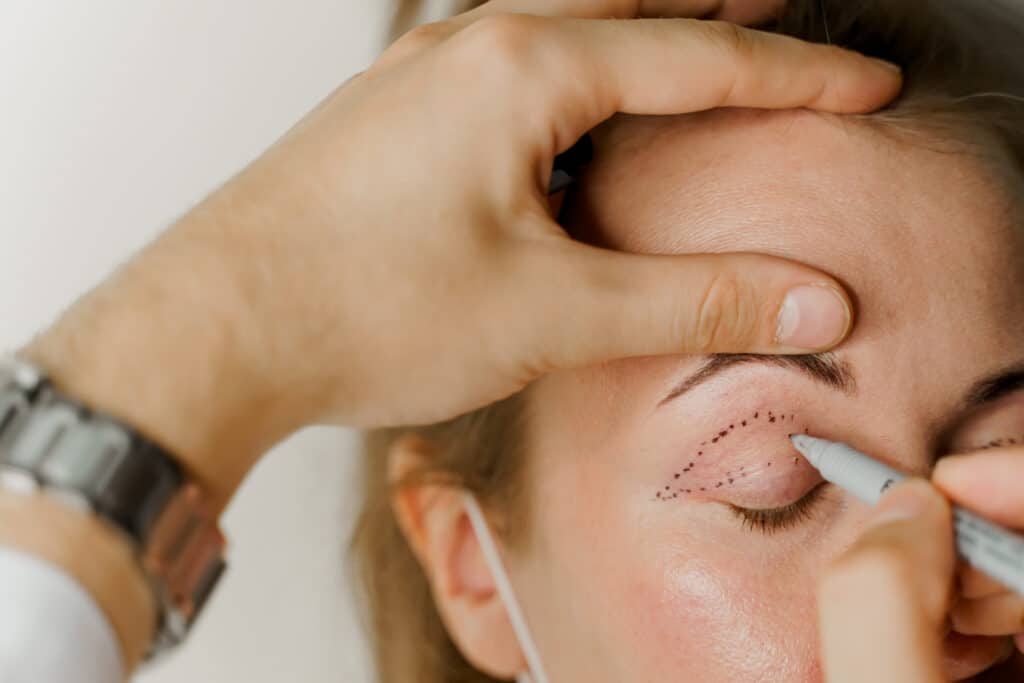 Doctor marking up woman's eyelid to prepare for blepharoplasty surgery