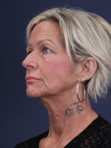 Before Image: Mini Facelift, Necklift, Stretched Earlobe Repair