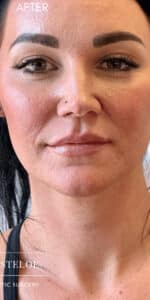 After Image: Lip Filler by Dr. Costeloe