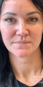 Before Image: Lip Filler by Dr. Costeloe