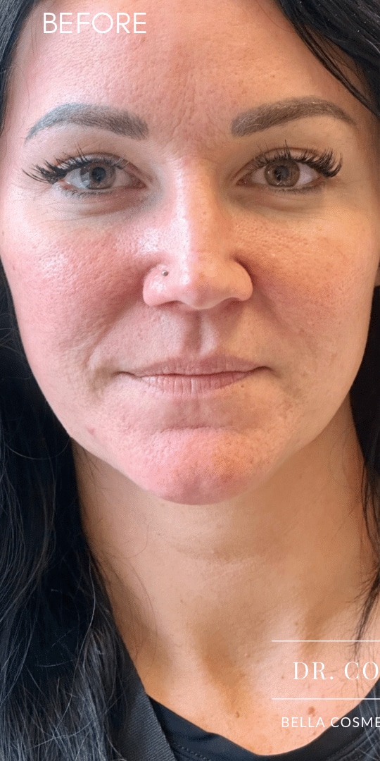 Before Image: Lip Filler by Dr. Costeloe - left-front-oblique