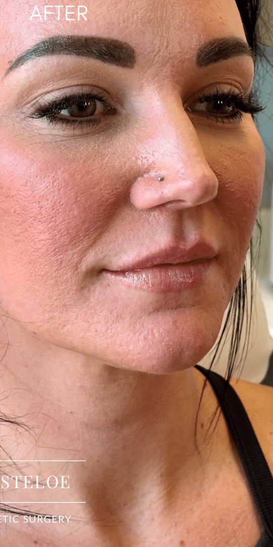 After Image: Lip Filler by Dr. Costeloe - right-front-oblique
