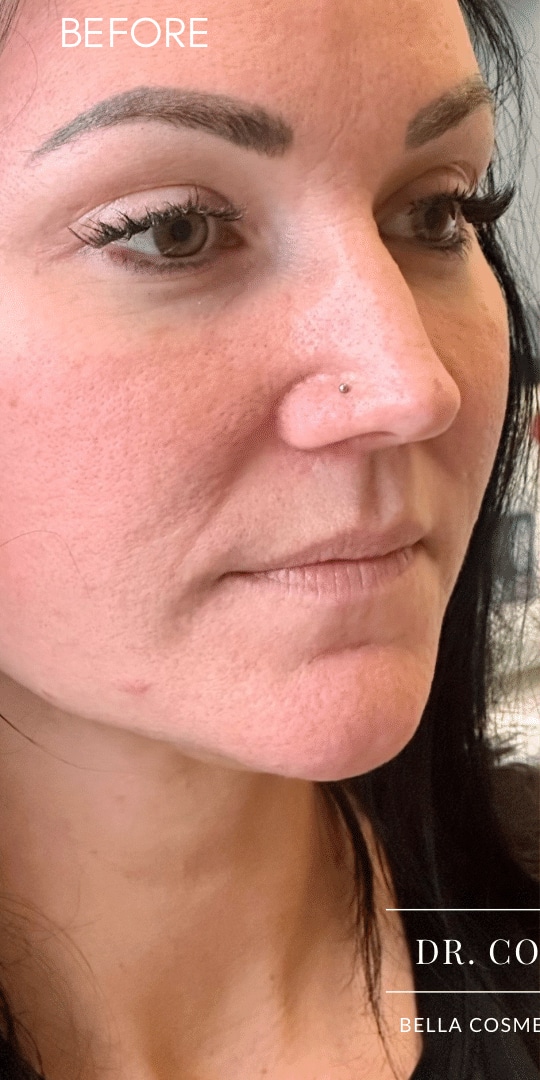 Before Image: Lip Filler by Dr. Costeloe - right-front-oblique