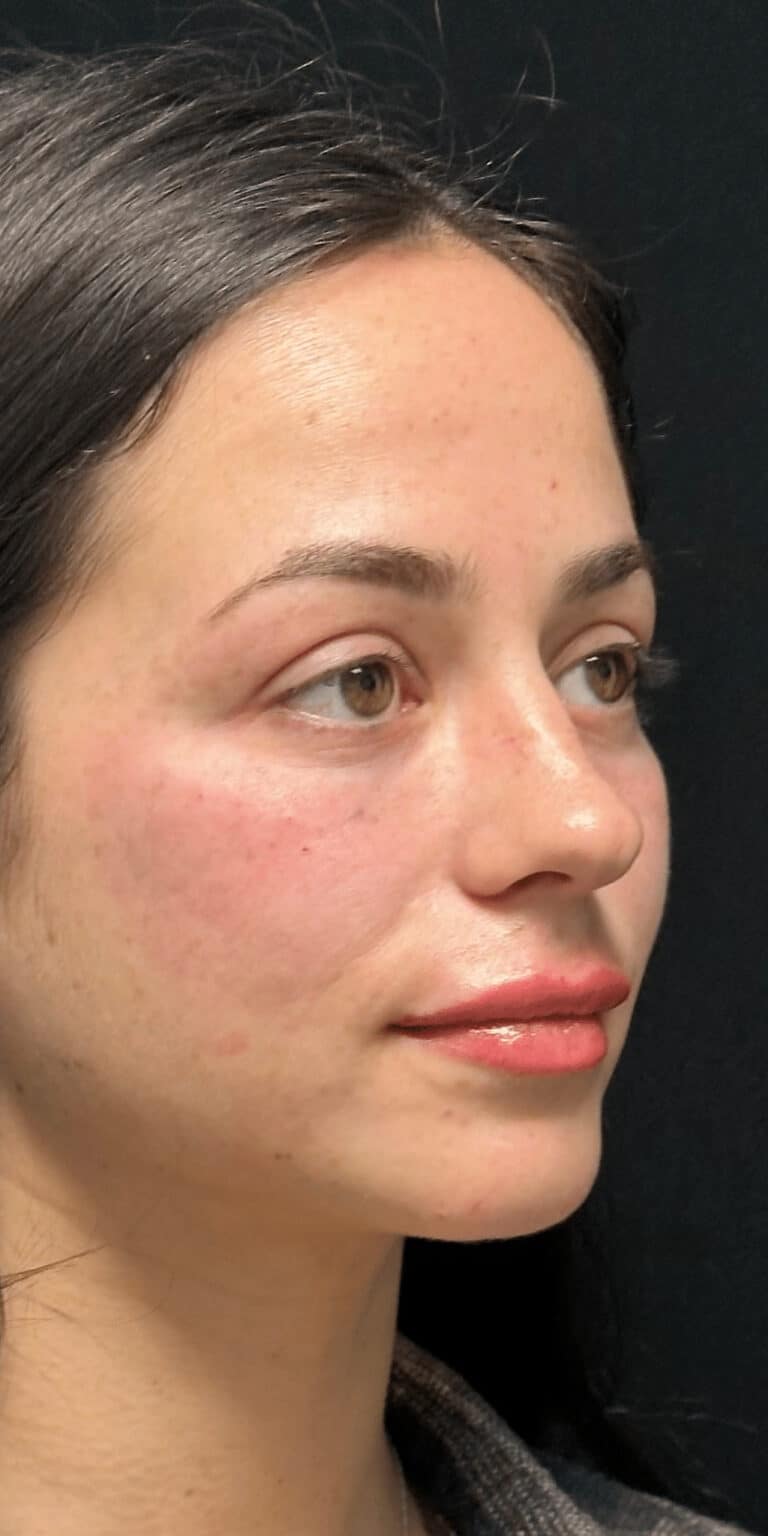 After Image: Facial rebalancing with hyaluronic acid filler - right-front-oblique