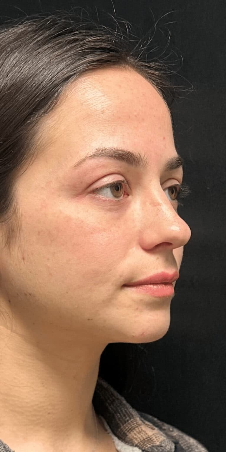 Before Image: Facial rebalancing with hyaluronic acid filler - right-front-oblique