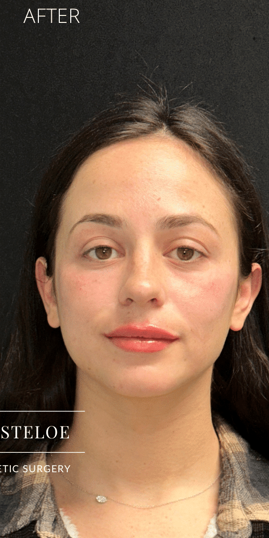 After Image: Facial rebalancing with hyaluronic acid filler -