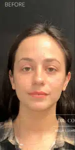 Before Image: Facial rebalancing with hyaluronic acid filler
