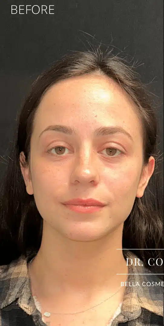 Before Image: Facial rebalancing with hyaluronic acid filler - 