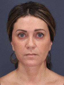 After Image: Deep Plane Face and Neck Lift