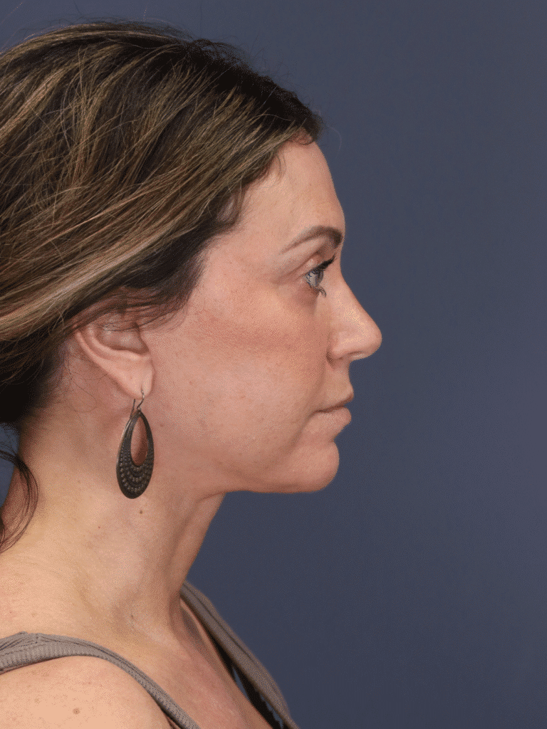After Image: Deep Plane Face and Neck Lift - right-side