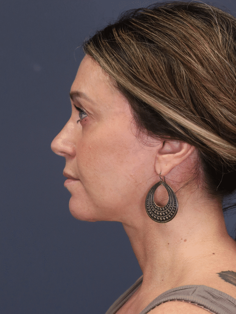 After Image: Deep Plane Face and Neck Lift - left-side