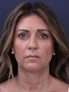 Before Image: Deep Plane Face and Neck Lift