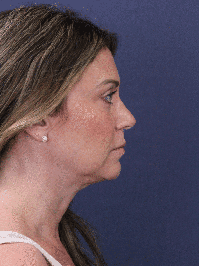 Before Image: Deep Plane Face and Neck Lift - right-side