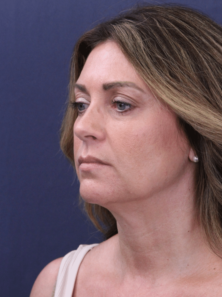 Before Image: Deep Plane Face and Neck Lift - left-front-oblique