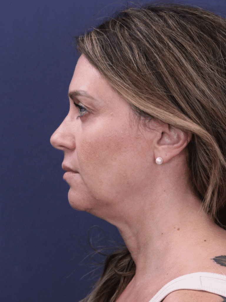 Before Image: Deep Plane Face and Neck Lift - left-side
