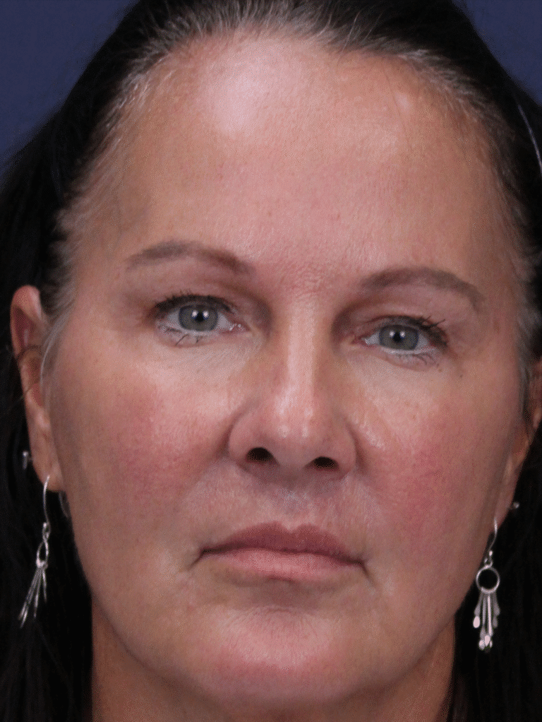 After Image: Lip Lift and Upper Eyelid Lift - front