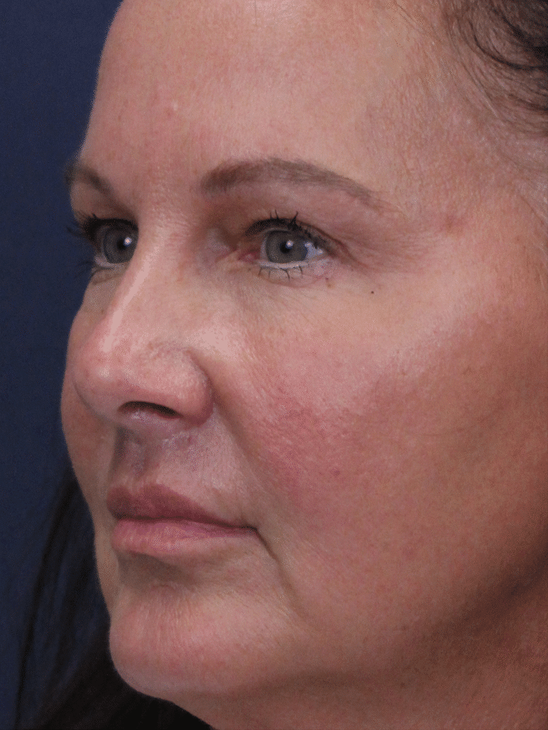 After Image: Lip Lift and Upper Eyelid Lift - left-front-oblique