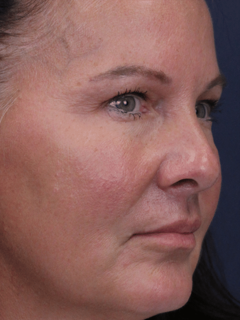 After Image: Lip Lift and Upper Eyelid Lift - right-front-oblique