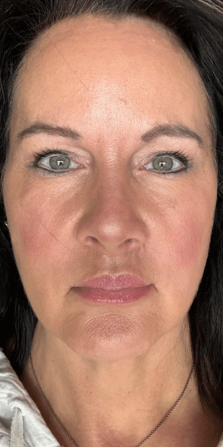 After Image: Lip Lift and Upper Eyelid Lift - front