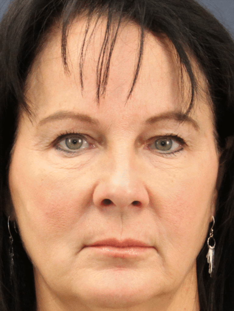 Before Image: Lip Lift and Upper Eyelid Lift - front