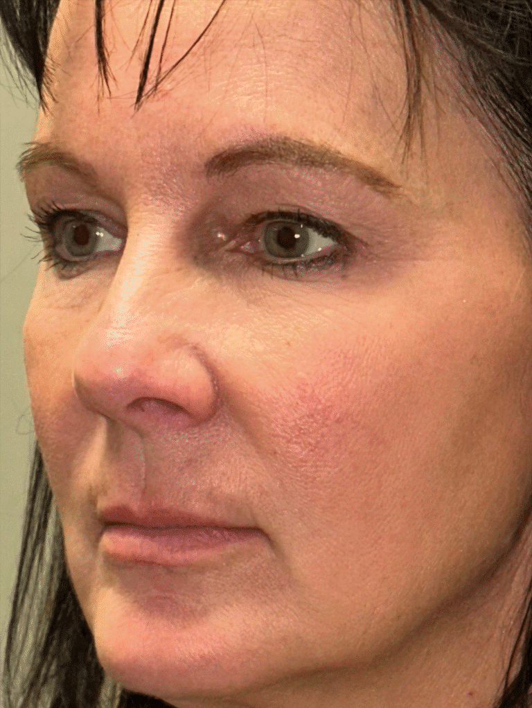 Before Image: Lip Lift and Upper Eyelid Lift - left-front-oblique