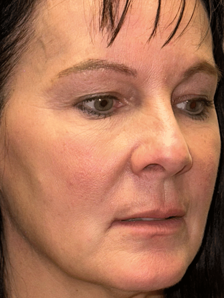 Before Image: Lip Lift and Upper Eyelid Lift - right-front-oblique