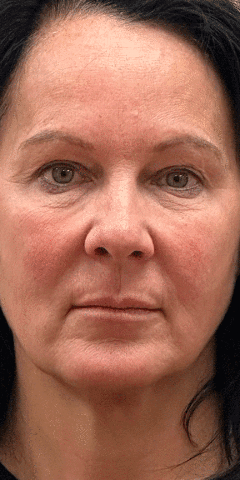 Before Image: Lip Lift and Upper Eyelid Lift - front