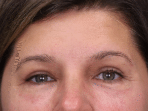 After Image: Upper and Lower Eyelid Lift, Under Eye Laser Resurfacing