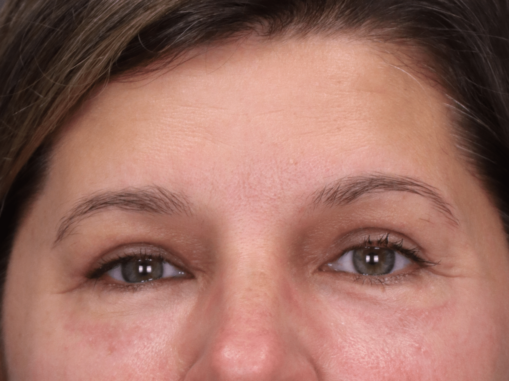 After Image: Upper & Lower Eyelid Lift, Fat Grafting & Under Eye Laser - front