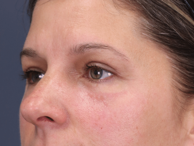 After Image: Upper and Lower Eyelid Lift, Under Eye Laser Resurfacing - left-front-oblique