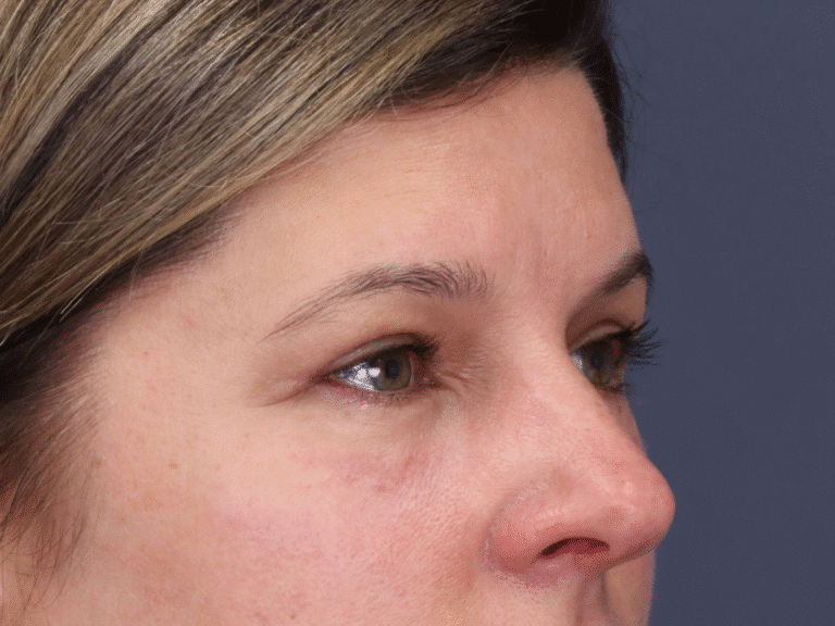 After Image: Upper and Lower Eyelid Lift, Under Eye Laser Resurfacing - right-front-oblique