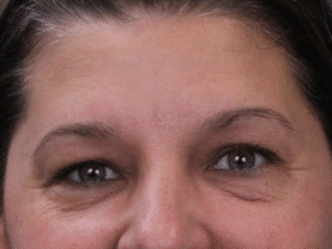 Before Image: Upper and Lower Eyelid Lift, Under Eye Laser Resurfacing